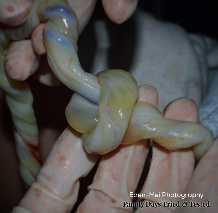 Umbilical cord knot